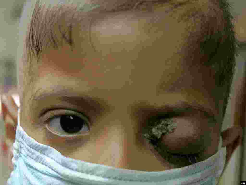 10.Više od 30% karcinoma bi moglo biti spriječeno pravilnom ishranom, nepušenjem,fizičkom aktivnošću, prevencijama... - Foto. Petogodišnji dječak snimljen u bagdadskom centru za karcinom, EPA - Faleh Kheiber